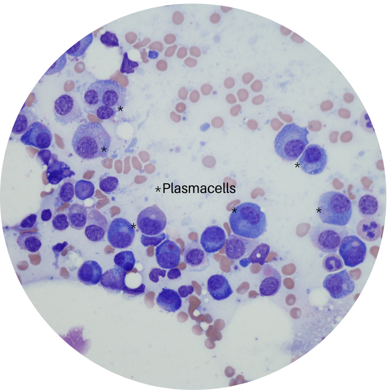 Plasmazellen im Knochenmark beim Multiplen Myelom