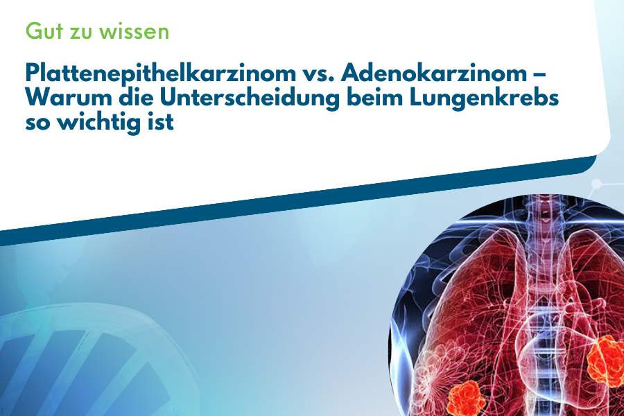 Beitragsbild zum Unterschied zwischen Plattenepithelkarzinom und Adenokarzinom mit Bild von Lungenkrebsmetastasen (schematisch)